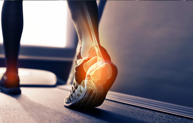 Άκανθα Πτέρνας.