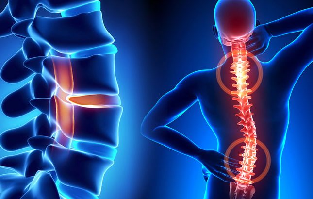 Κήλη Μεσοσπονδυλίου Δίσκου.